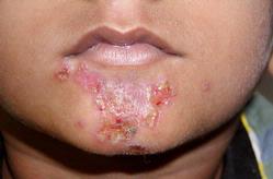 Impetigo | Patologias Dermatologicas