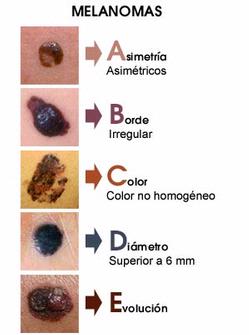 Melanoma | Patologias Dermatologicas