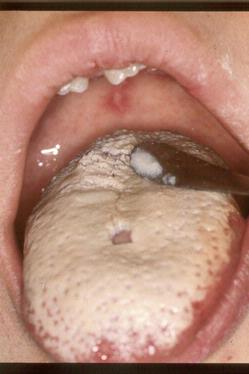 Candidiasis | Patologias Dermatologicas