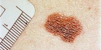 Lunares o Nevus Melanocíticos-La Dermatoscopia Digital es la forma más segura de seguimiento de los lunares