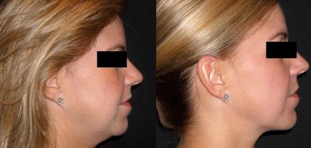 lipolarser-3-iderma.jpg