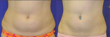 lipolarser-4-iderma.jpg