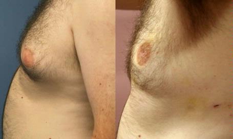 lipolarser-6-iderma.jpg