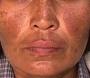 Cloasma | Patologias Dermatologicas