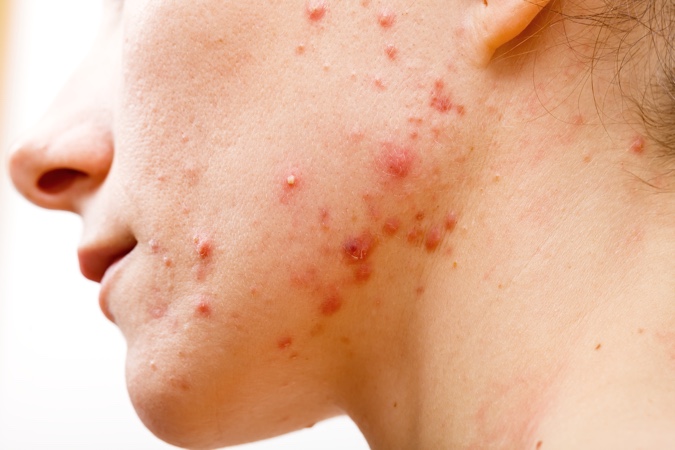 tratamiento acne isotretinoina