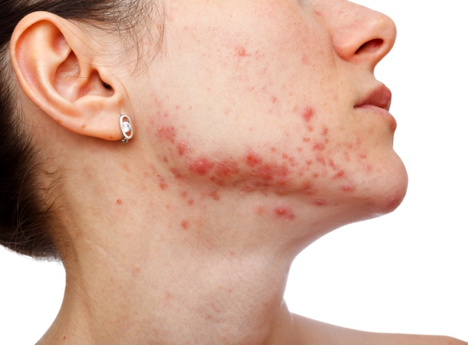 tratamiento acne con isotretinoina