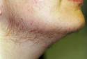 Hirsutismo | Patologias Dermatologicas