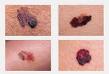 Lunar | Patologias Dermatologicas