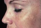 Melasma | Patologias Dermatologicas