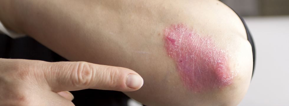 Psoriasis