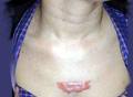 Queloides | Patologias Dermatologicas