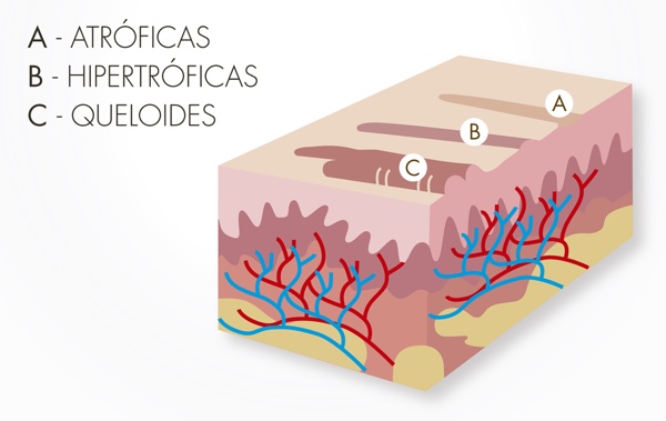 tipos cicatrices
