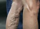 Varices | Patologias Dermatologicas