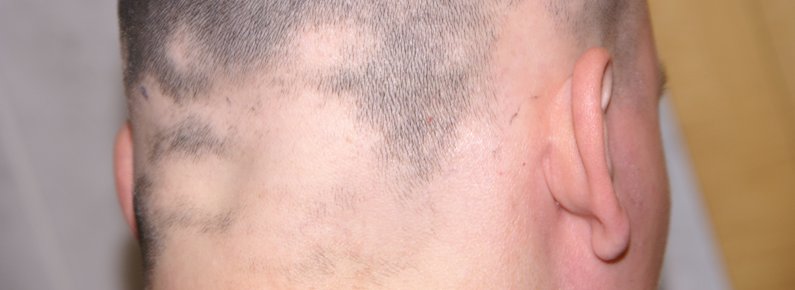 Alopecia areata