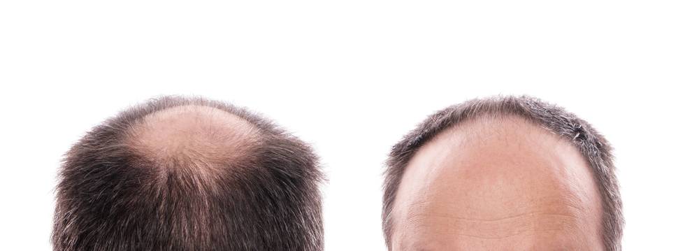¿Cómo se manifiesta la alopecia androgenética?