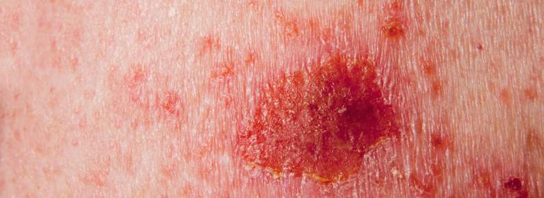 El seguimiento del cáncer de piel permite detectar recaídas en casi el 80% de los casos
