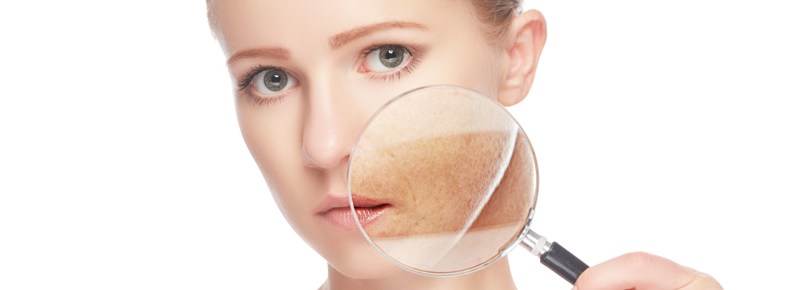 Melasma