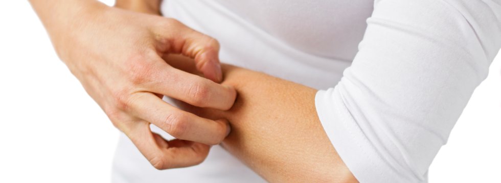Dermatitis atópica Infantil