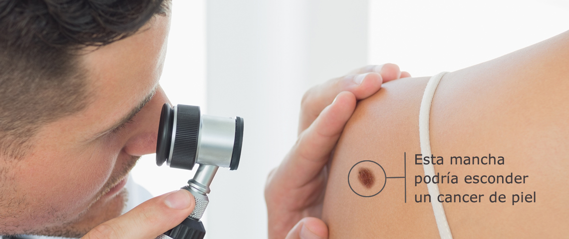 Calcula tu riesgo de padecer un Cáncer de piel