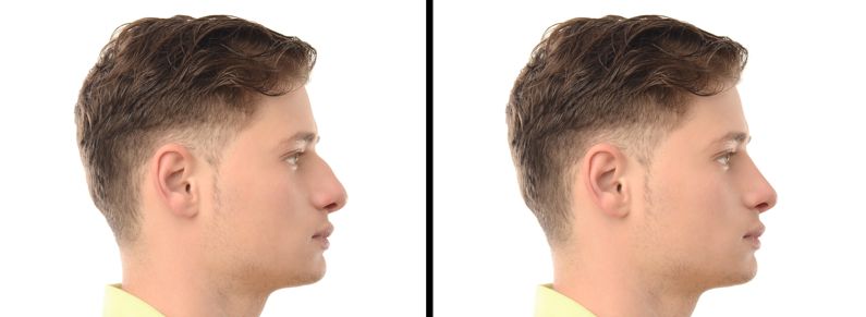 Remodelación nasal