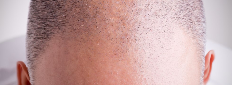 Las técnicas FUSS y FUE en el trasplante de pelo