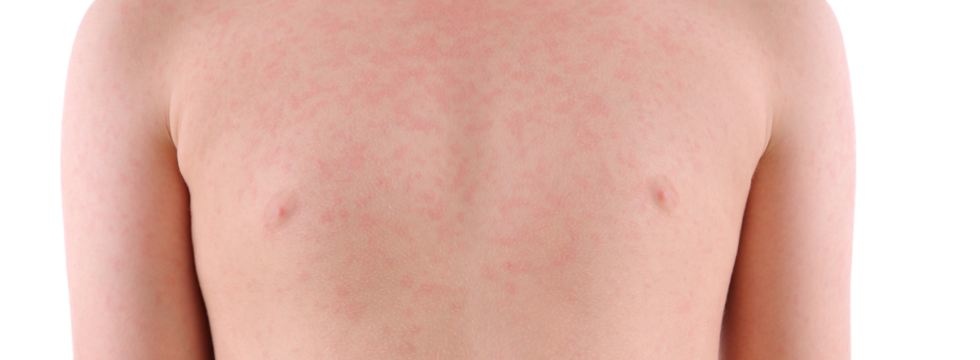 Urticaria